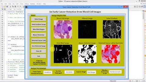Matlab Project for Leukemia Blood Cancer Detection Using Image Processing