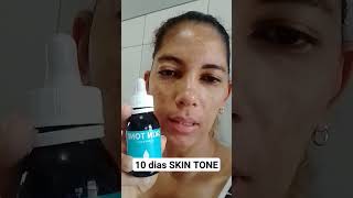 10 dias usando SKIN TONE pra melasma e manchas de espinhas.