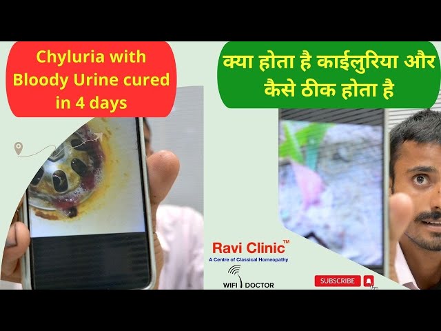 Chyluria with Milky and Bloody Urine got cured in 4 days - Dr Ravi Singh