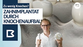 Knochenaufbau für Zahnimplantate - Alle Möglichkeiten genau erklärt!