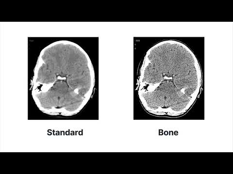 What happens during the reconstruction process to create a CT image?: CT physics