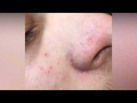 Men in Blackheads! Most Pops Ever!