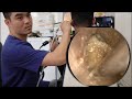💫耳かき | 耳掃除 | 二分性中耳炎 DR. LAI MINH TUAN