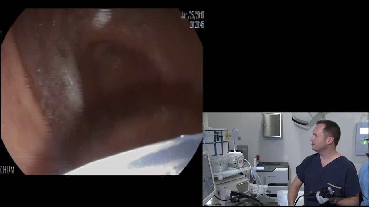 Assessment And Sampling Of Pancreatic Head Mass YouTube assessment-and-sampling-of-pancreatic-head-mass-youtube