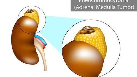 Laboratory findings For Pheochromocytoma Or Catecholamine Crisis (Diagnosis Guide)