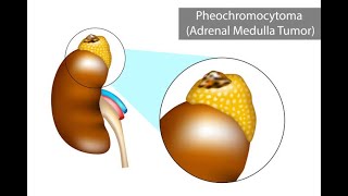 Laboratory findings For Pheochromocytoma Or Catecholamine Crisis (Diagnosis Guide)