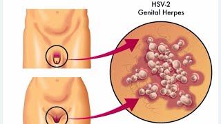 العلاج القمعي لمرض #الهربيس_التناسلي