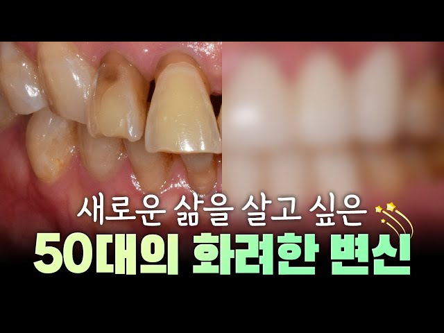 👵50대도 찾는 치아교정과 보철치료 (feat.지르코니아 크라운)