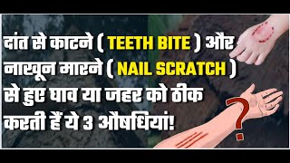 दांत से काटने  और नाखून मारने  से हुए घाव या जहर को ठीक करती हैं ये 3 औषधियां!