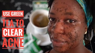 Green tea acne treatment; how to use ...