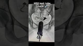 “HSG test me fallopian tubes check ki jaati hain 💉 #HSG #fertility #womenshealth#explore #shorts