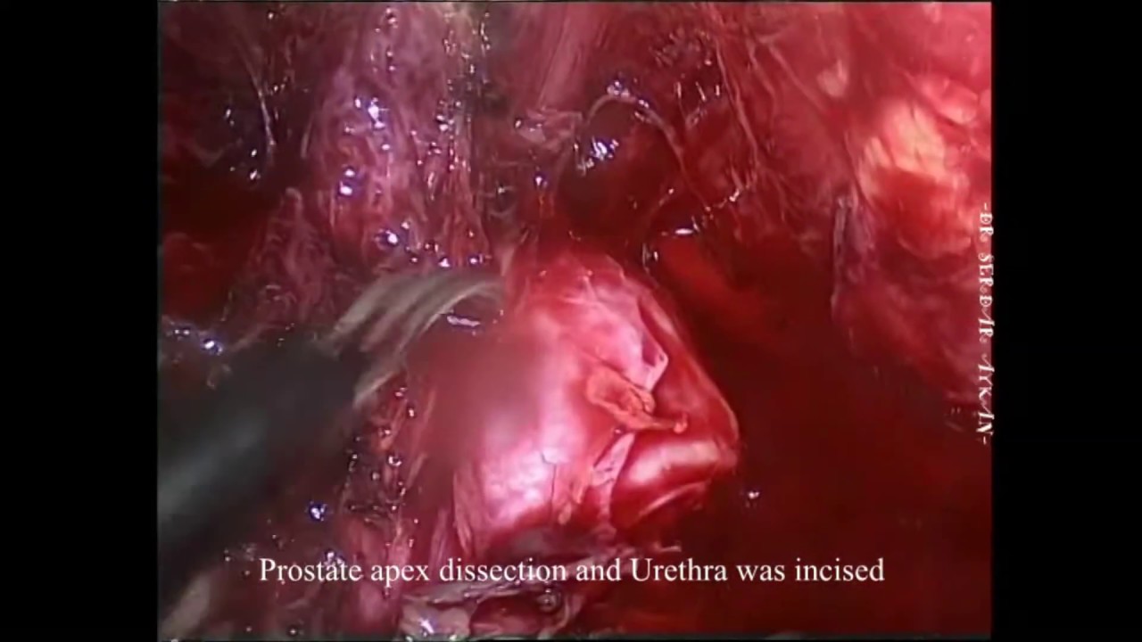 SA-1 transperitoneal laparoscopic radical prostatectomy ( Serdar AYKAN, MD )