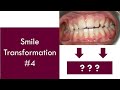 Smile Transformation #4 | Dr. Jiten Vadukul | The Orthodontist