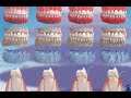 मसूड़े की सूजन, पीरियडोंटाइटिस और इसका विकास (gum disease evolution) ©