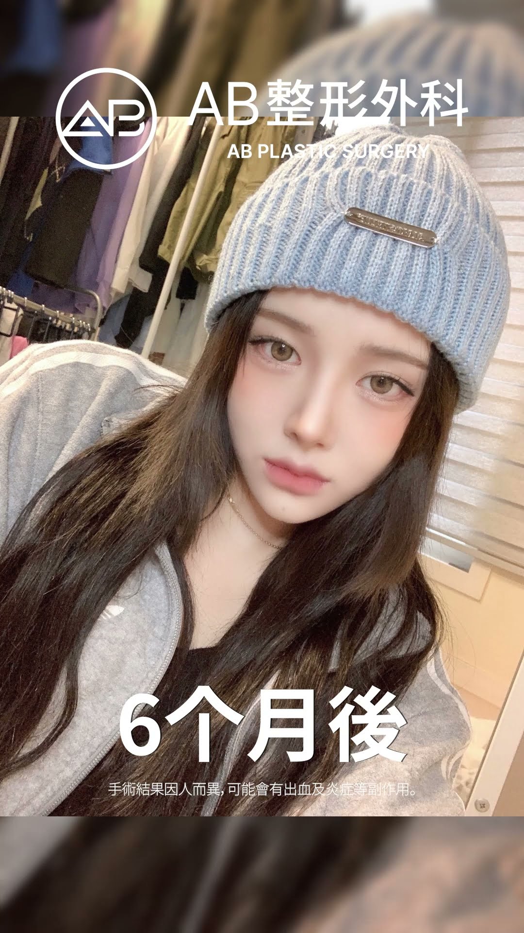美貌重生？看她整形後的驚人蛻變！👀 #热门 #推荐