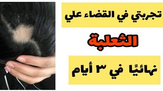 داء الثعلبة وعلاجها بالزيوت والاعشاب والقران