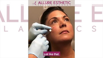 Under Eye Filler Injection | Tear Trough Filler with Cannula