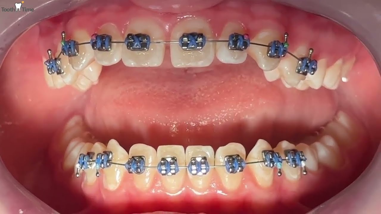 FULL Braces Placement!! Tooth Time Family Dentistry
