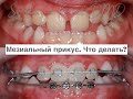 Мезиальный прикус, сужение верхней челюсти  Планирование ортодонтического лечения