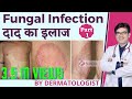 Fungal Infection Treatment In Hindi | फ़ंगल इन्फ़ेक्शन का इलाज हिंदी में | Dermatologist | Dr Sunil