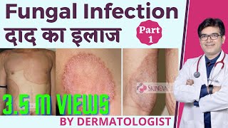 Fungal Infection Treatment In Hindi | फ़ंगल इन्फ़ेक्शन का इलाज हिंदी में | Dermatologist | Dr Sunil