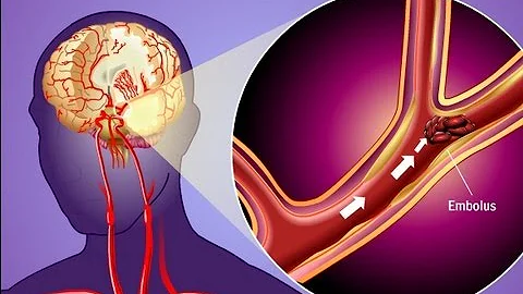 Stroke Prevention & Transient Ischemic Attack (TIA) - DayDayNews