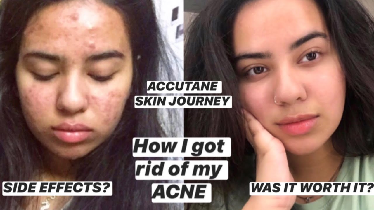 HOW I GOT RID OF MY ACNE AFTER 6 YEARS | My skin journey on Accutane ...