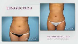 Beverly Hills Liposuction | Dr. William Bruno