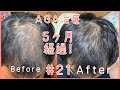 AGA治療5ヶ月経過！時間をかけてここまで来れました!
