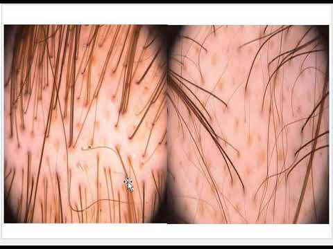 Video: Androgen Alopeci Hos Kvinnor - Behandling, Prognos