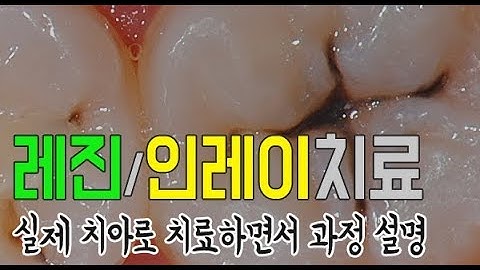 충치치료 레진/인레이 치료과정 [실제 치아로 치료하면서 설명]