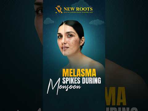 Why Melasma Spikes During Monsoon | Causes & Dermatologist Tips #melasma #shorts