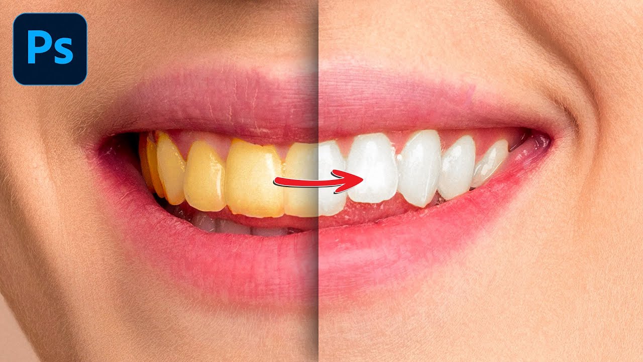 Se pueden arreglar los dientes desgastados