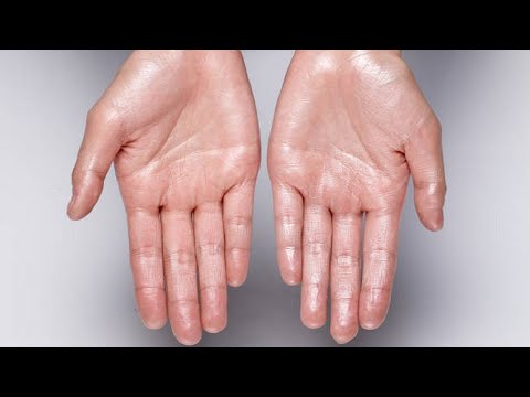Video Nguyên Nhân Ra Mồ Hôi Tay Và 11 Cách Kiểm Soát Tại Nhà - youtube