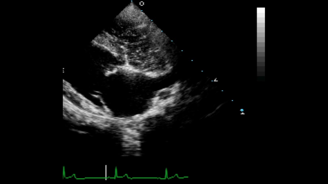 Contrast Echocardiogram of Atrial Septal Defect (ASD) - Dog (Standard ...