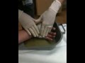 Tosh.0 worthy video grease fire, huge blister