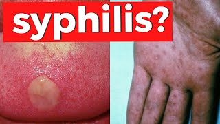 SYPHILIS - Everything You Need To Know about Treponema Pallidum