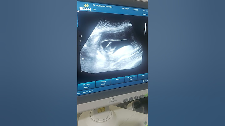 تجمع دموي حول كيس الحمل  🏝🏝🏝Subchorionic hemorrhage🤲Male baby🤲