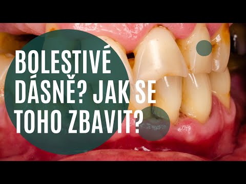 Video: 3 jednoduché způsoby léčby zánětu dásní doma