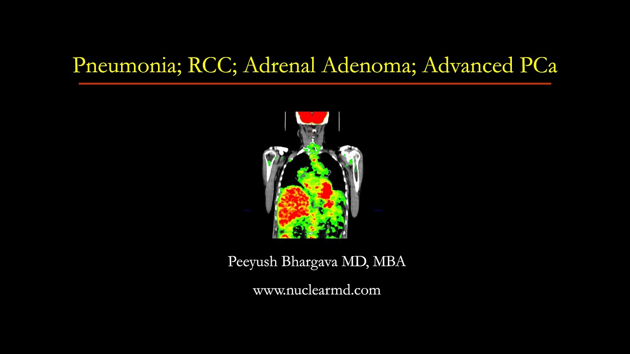 Pneumonia; RCC; Adrenal Adenoma; Advanced PCa - YouTube