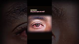 Why Your Eyes Are Red ??