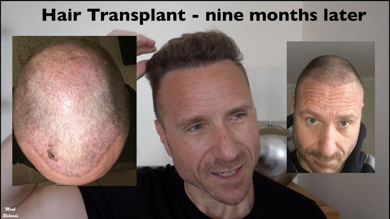 Elit Hair Transplant Turkey - DrBalwi - This patient looks 10 years  younger after his hair transplantation, do you like it? - Facebook