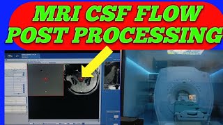 MRI BRAIN CSF FLOW POST PROCESSING @MRI CSF FLOW PROCESSING @CSF FLOW MRI STUDY @MRI CSF FLOW STUDY