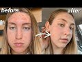 HOW I CLEARED MY SKIN IN 30 DAYS! *acne transformation*