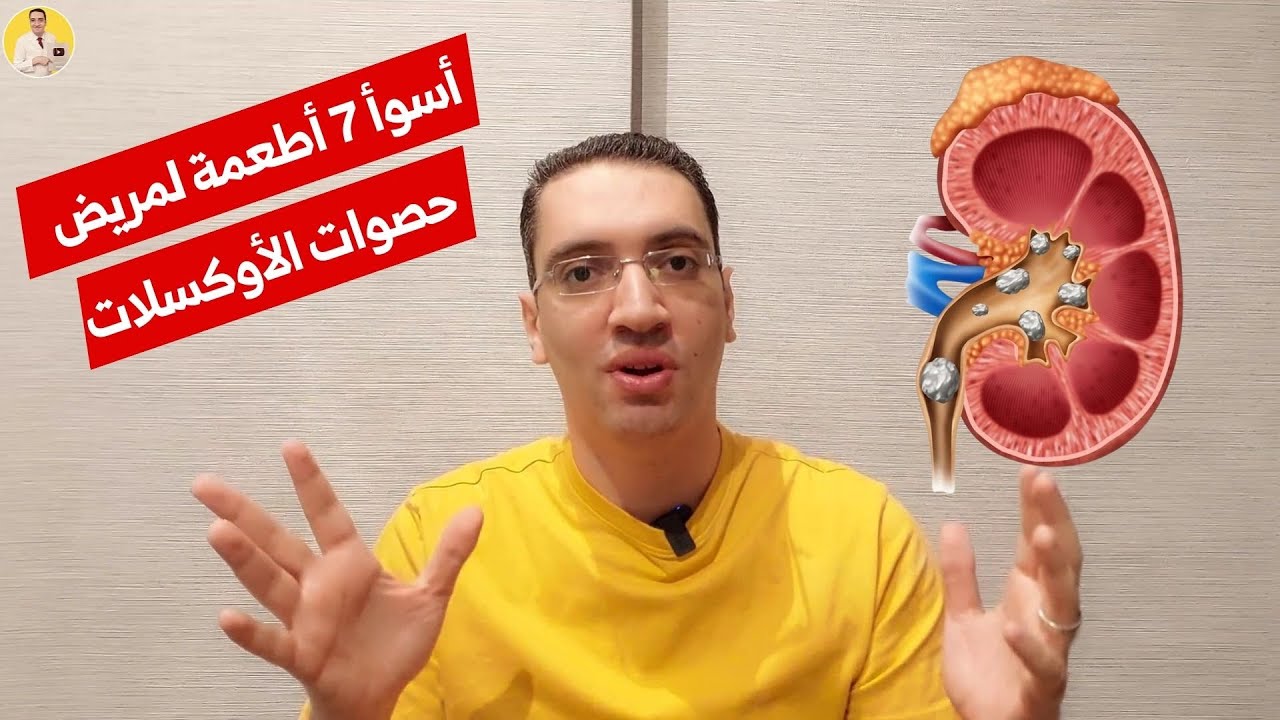 اسوأ 7 اطعمة لمريض حصوات الاوكسلات - حصوات الكلى الاوكسلات