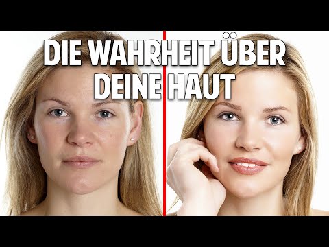 Video: Warum Der Kampf Gegen Psoriasis Mehr Als Nur Hauttief Ist