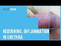 Reddening Inflammation In Urethra After Anal Sex