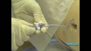 Seldinger Chest Drain procedure by Bromley Emergency Courses