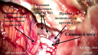 Гигантская эпидермоидная опухоль IV желудочка 2 часть