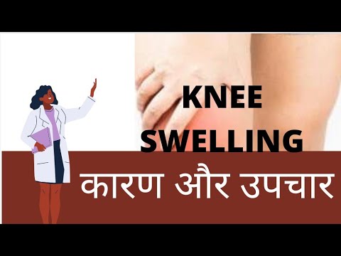 KNEE SWELLING HINDI - घुटने का दर्द (कारण और उपचार) | knee pain in